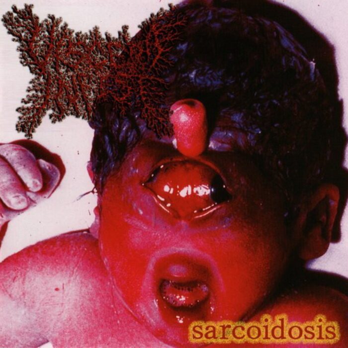 Viscera Infest - Sarcoidosis